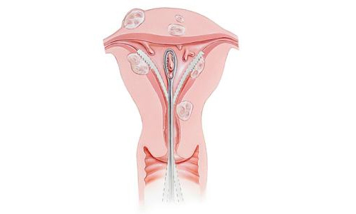 Biopsja Aspiracyjna Endometrium – Pipelle